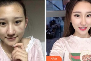 蚌埠華美整形美容門診部袁振奮整形價格表附微創(chuàng)疤痕修復(fù)案例展示