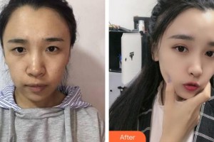 蚌埠市第三人民醫(yī)院燒傷整形科李方奇整形價格表附眼部綜合案例展示