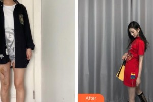 蚌埠市第三人民醫(yī)院燒傷整形科李勇整形價格表附微創(chuàng)疤痕修復(fù)案例展示