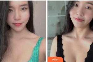 蚌埠美愿醫(yī)療整形醫(yī)院李鴻君整形價格表附豐胸案例展示