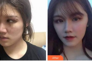蚌埠韓麗整形美容醫(yī)院洪志堅(jiān)整形價格表附埋線提升案例展示
