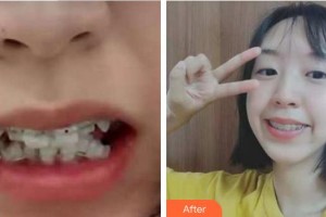 蚌埠華美整形美容門診部楊松整形價格表附牙齒陶瓷矯正案例展示