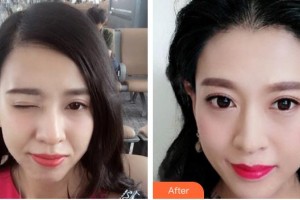 蚌埠韓麗整形美容醫(yī)院曺在賢整形價格表附種植發(fā)際線案例展示