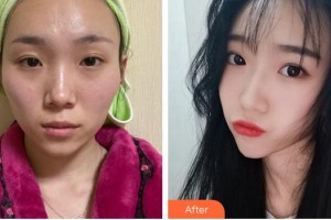 蚌埠韓麗整形美容醫(yī)院李準(zhǔn)馥整形價格表附顴骨內(nèi)推案例展示