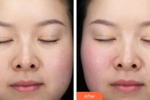 蚌埠韓麗整形美容醫(yī)院安泰柱整形價格表附面部輪廓案例展示