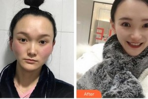 蚌埠靚妹醫(yī)療美容門診部魯立整形價格表附顴骨顴弓整形術(shù)案例展示