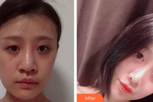 蚌埠韓麗整形美容醫(yī)院樸鐘范整形價格表附鼻部整形案例展示