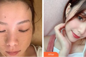 蚌埠靚妹醫(yī)療美容門(mén)診部黎娜整形價(jià)格表附埋線提升案例展示