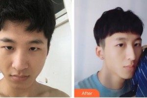 蚌埠美萊塢整形美容醫(yī)院姚然整形價(jià)格表附鼻部綜合案例展示