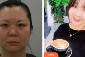 蚌埠時(shí)光鎖美容整形外科診所馬世龍整形價(jià)格表附埋線提升案例展示