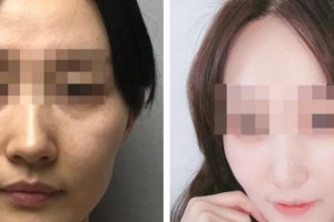 蚌埠立方醫(yī)療美容整形醫(yī)院王樹(shù)立整形價(jià)格表附埋線提升案例展示