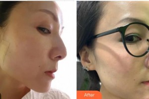 蚌埠華美整形美容門(mén)診部官赳駒整形價(jià)格表附埋線提升案例展示