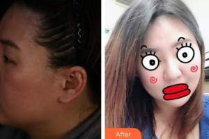 蚌埠華美整形美容門(mén)診部劉敏整形價(jià)格表附埋線提升案例展示