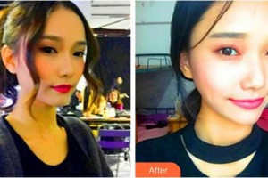 蚌埠韓美美萊醫(yī)療美容門(mén)診部陳澤整形價(jià)格表附熱瑪吉案例展示