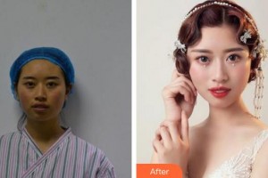 蚌埠韓美美萊醫(yī)療美容門(mén)診部張濤整形價(jià)格表附埋線提升案例展示