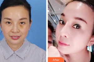 蚌埠韓美美萊醫(yī)療美容門(mén)診部歷芳整形價(jià)格表附埋線提升案例展示