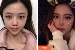 蚌埠康視眼科醫(yī)院葉金星整形價(jià)格表附眼部綜合案例展示