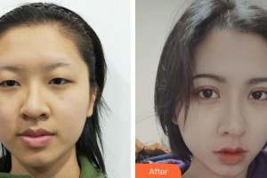 蚌埠康視眼科醫(yī)院汪蕾整形價(jià)格表附開(kāi)內(nèi)眼角案例展示