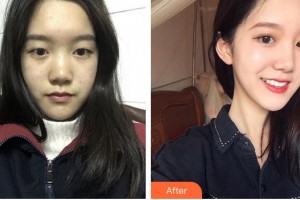 蚌埠康視眼科醫(yī)院王茜珂整形價(jià)格表附眼部綜合案例展示