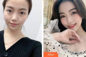 蚌埠康視眼科醫(yī)院畢燈輝整形價(jià)格表附埋線雙眼皮案例展示