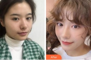 淮南麗人醫(yī)院整形美容科熊秋萍整形價格表附熱瑪吉案例展示