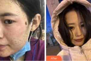 淮南瑞麗醫(yī)療美容門診部李倩倩整形價格表附激光美膚激光案例展示