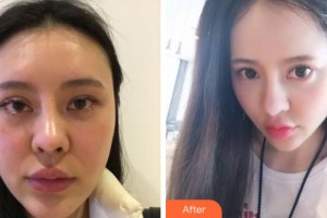 淮南凱婷美琪醫(yī)療美容醫(yī)院魯立菊整形價格表附埋線提升案例展示