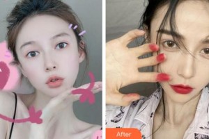 淮南麗顏醫(yī)療整形醫(yī)院劉建東整形價格表附耳軟骨復合隆鼻案例展示