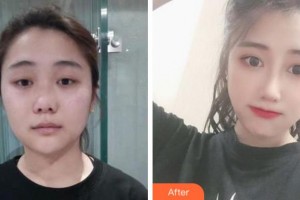 淮南美橙醫(yī)療整形美容醫(yī)院李韻芳整形價格表附肋軟骨隆鼻案例展示