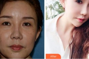 淮南澤明眼科醫(yī)院（原淮南東方醫(yī)院集團眼科醫(yī)院）張玲整形價格表附外切祛眼袋案例展示