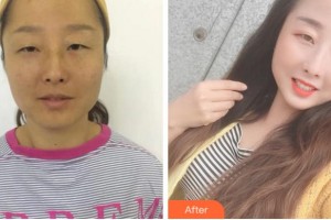 淮南華廈眼科醫(yī)院李建東整形價格表附內(nèi)切祛眼袋案例展示