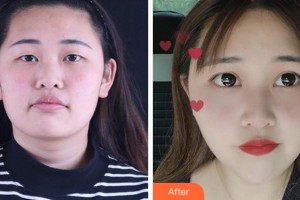 淮南澤明眼科醫(yī)院（原淮南東方醫(yī)院集團眼科醫(yī)院）王丹梅整形價格表附眼部綜合案例展示