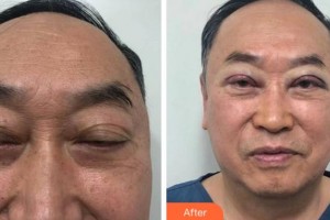 淮南澤明眼科醫(yī)院（原淮南東方醫(yī)院集團眼科醫(yī)院）劉志剛整形價格表附切開雙眼皮案例展示