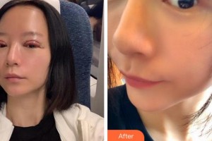 淮南華廈眼科醫(yī)院朱攀攀整形價格表附切開雙眼皮案例展示