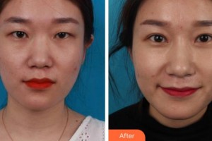 淮南北方醫(yī)院眼科廖茉莉整形價格表附切開雙眼皮案例展示