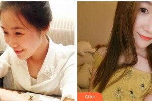 馬鞍山東方婦產(chǎn)醫(yī)院中韓整形美容中心吳堅整形價格表附熱瑪吉案例展示