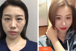 馬鞍山福華醫(yī)療美容醫(yī)院董帆整形價格表附鼻部綜合案例展示