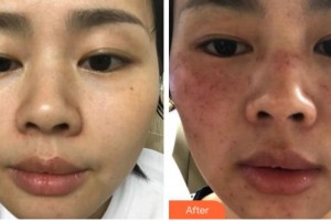 馬鞍山柯匯醫(yī)療美容醫(yī)院張志強(qiáng)整形價格表附激光美膚激光案例展示