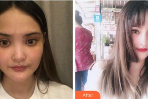 馬鞍山御星醫(yī)療美容醫(yī)院張少翔整形價格表附耳軟骨復(fù)合隆鼻案例展示