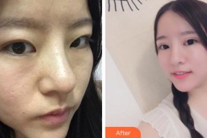 馬鞍山愛爾眼科醫(yī)院徐六三整形價格表附切開雙眼皮案例展示