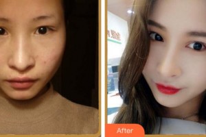 馬鞍山愛爾眼科醫(yī)院周慧婷住院醫(yī)師整形價格表附眼部綜合案例展示