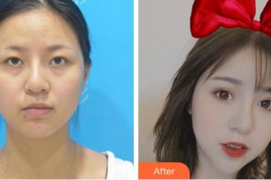 馬鞍山康視眼科醫(yī)院蔣平整形價格表附眼部綜合案例展示