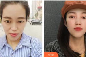 馬鞍山康視眼科醫(yī)院李華整形價格表附切開雙眼皮案例展示