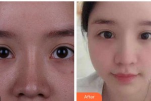 馬鞍山康視眼科醫(yī)院高衛(wèi)萍整形價格表附眼部修復(fù)案例展示