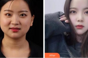 馬鞍山康視眼科醫(yī)院王子南整形價格表附眼部綜合案例展示