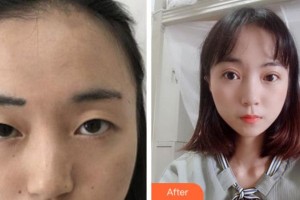 馬鞍山康視眼科醫(yī)院王育良整形價格表附切開雙眼皮案例展示