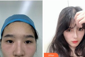 馬鞍山康視眼科醫(yī)院劉虎整形價格表附眼部修復(fù)案例展示