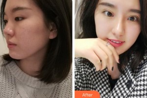 馬鞍山康視眼科醫(yī)院李一壯整形價格表附眼部整形案例展示