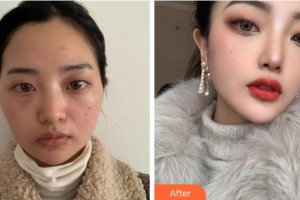 淮北東方美萊塢醫(yī)療美容醫(yī)院韓弘燮整形價格表附顴骨+下頜角案例展示