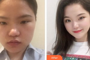 廣州軍美整形醫(yī)院顏玲整形價格表附隆鼻案例展示